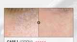 Medifault Phytogenpeel Ampoule 60ml, Skin Texture Keratin Whitehead Improvement,Kbeauty