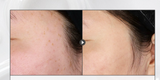 Medifault Phytogenpeel Ampoule 60ml, Skin Texture Keratin Whitehead Improvement,Kbeauty
